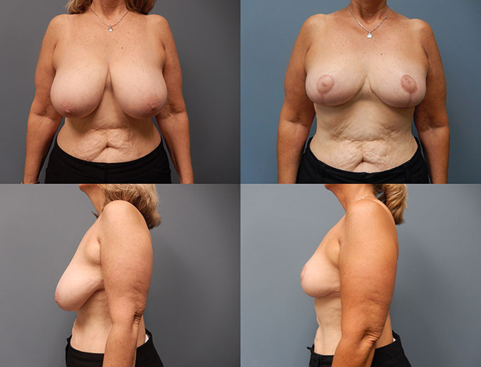 Breast Reduction Raleigh Patient 97 4 months