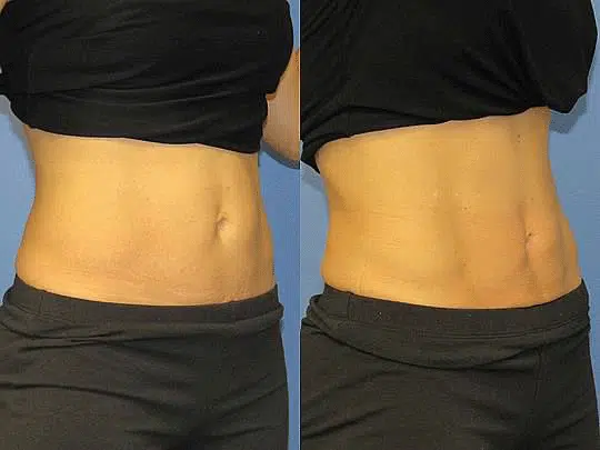 CoolTone Abs Before and After
