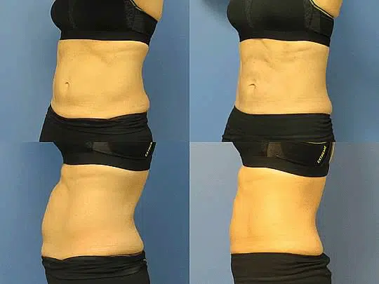 CoolTone Abs Before and After
