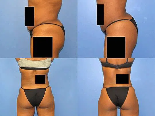 CoolTone Glutes Before and After