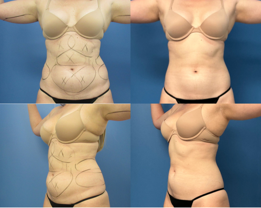 CoolSculpting Before & After