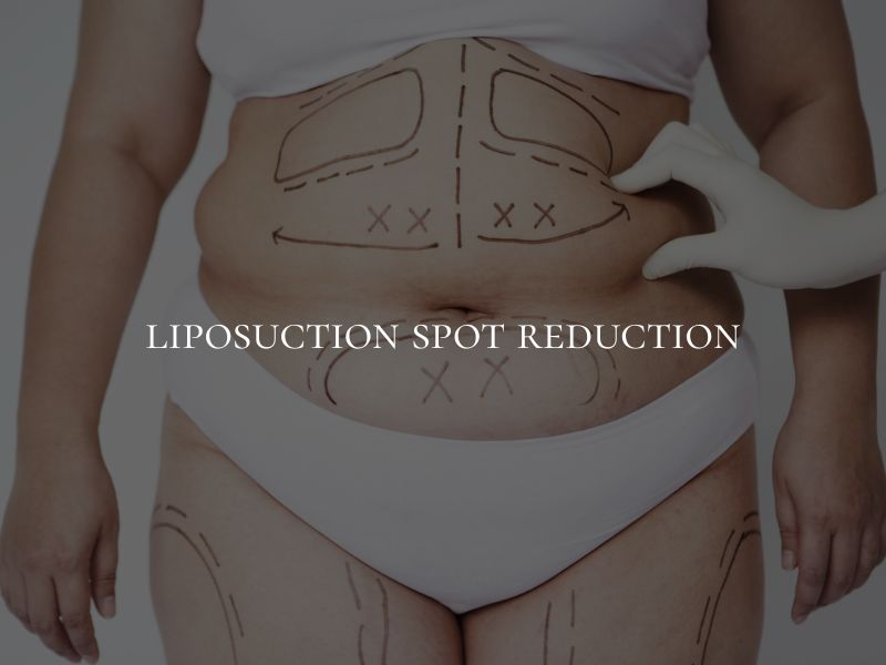 liposuction spot reduction