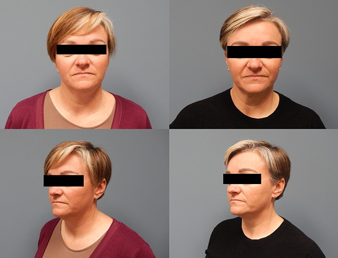 Submental Chin Lipo Patient 149