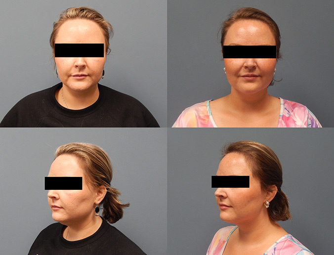 Submental Chin Lipo Patient 150 6mo