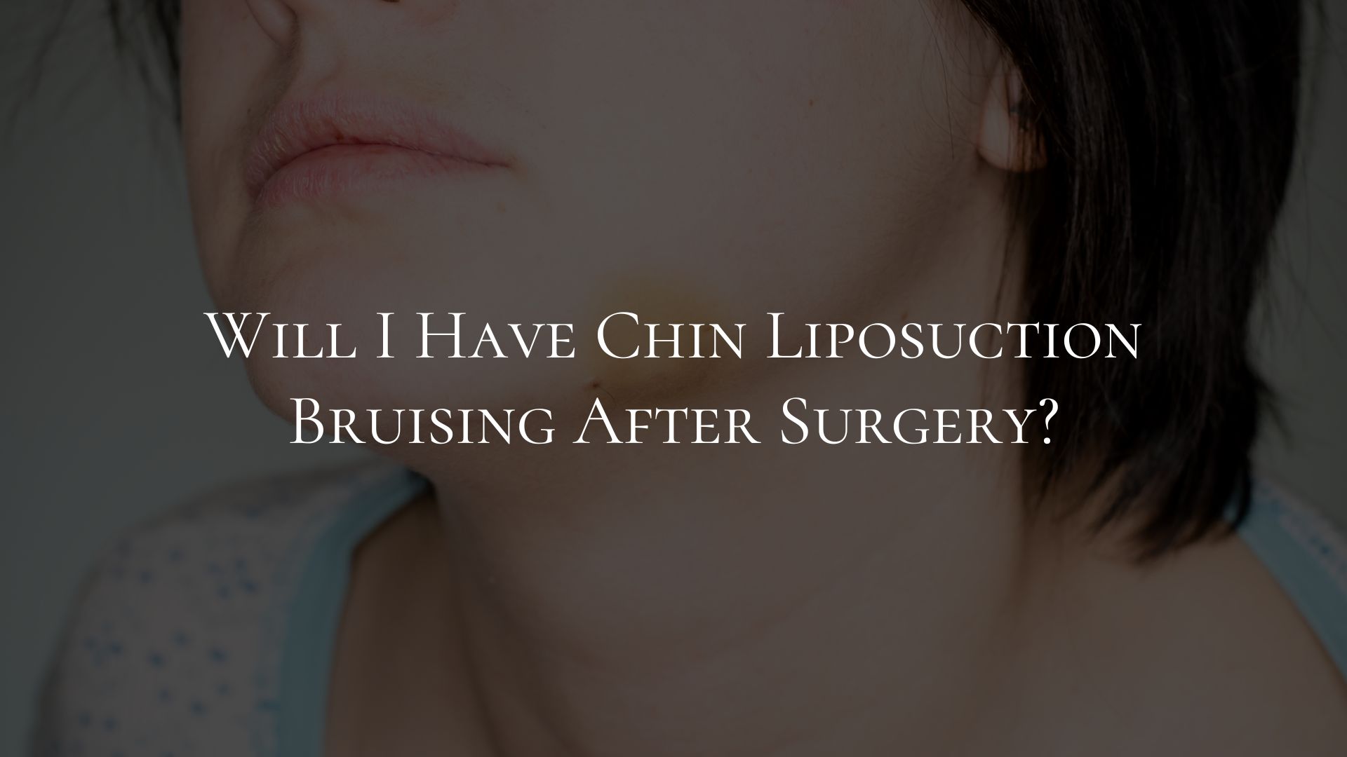 Will I Have Chin Liposuction Bruising After Surgery