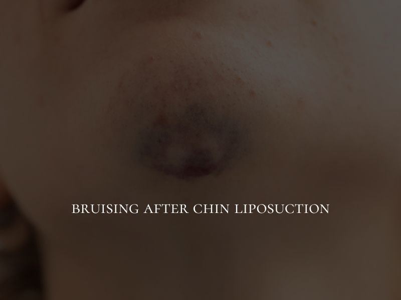 bruising after chin liposuction