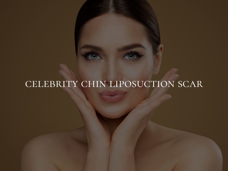 celebrity chin liposuction scar