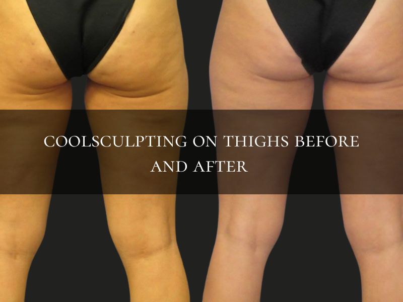 cellulite coolsculpting before and after thighs