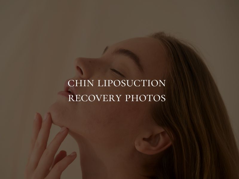 chin liposuction recovery photos