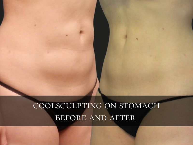 coolsculpting before and after stomach