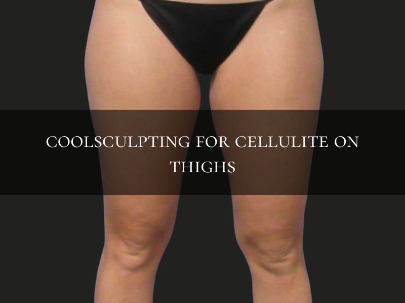 coolsculpting for cellulite on thighs