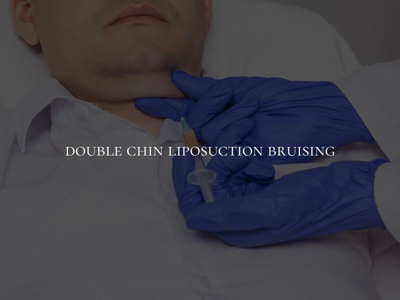 double chin liposuction bruising