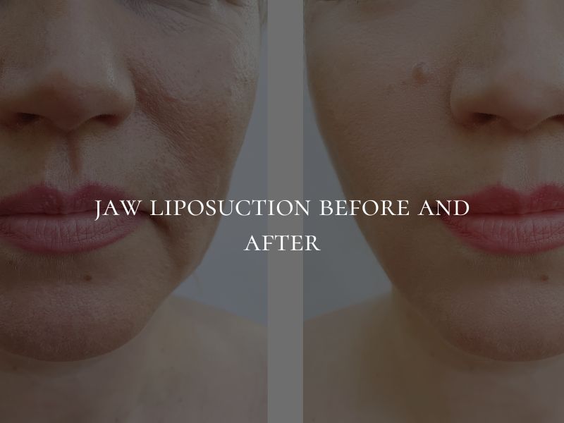 jaw liposuction before and after