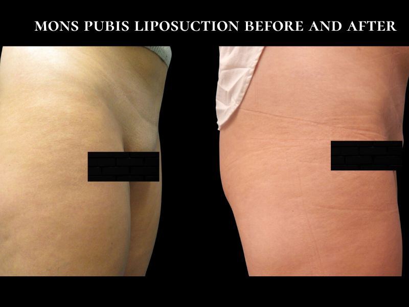 liposuction mons pubis before and after