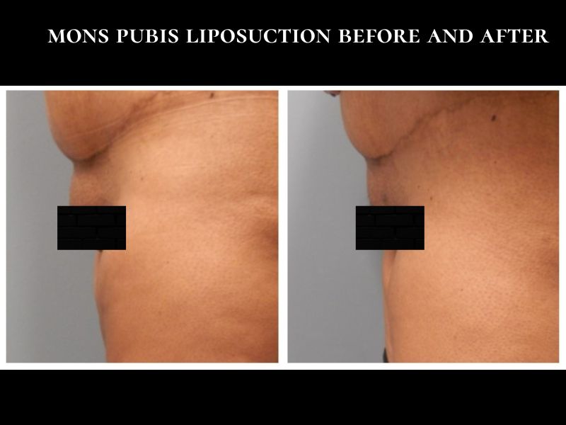 liposuction on mons pubis before and after