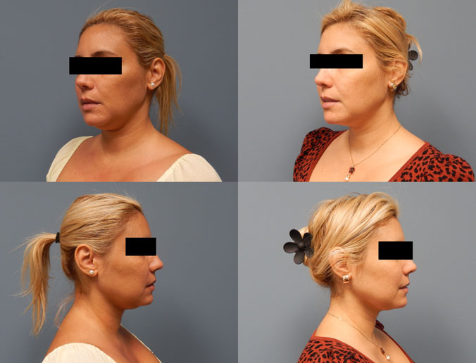 submental lipo Patient 130