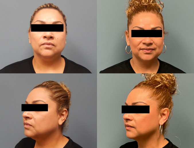submental lipo Patient 158