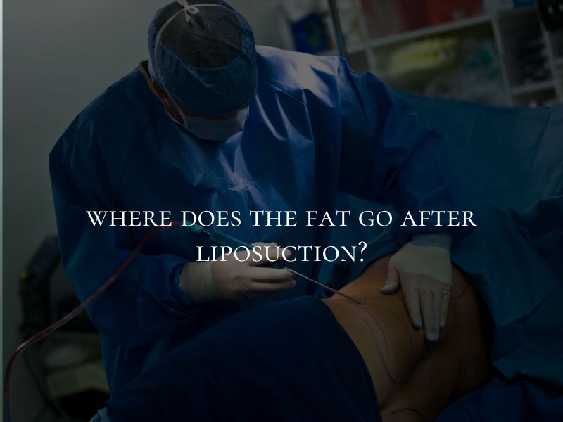 where does the fat go after liposuction